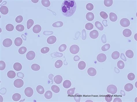 sideroblastic anemia lab findings|Sideroblastic Anemia – A Laboratory Guide to Clinical .